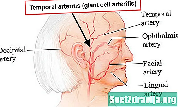 Temporär Arteritis