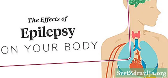 Els efectes de l’epilèpsia sobre el cos - Benestar