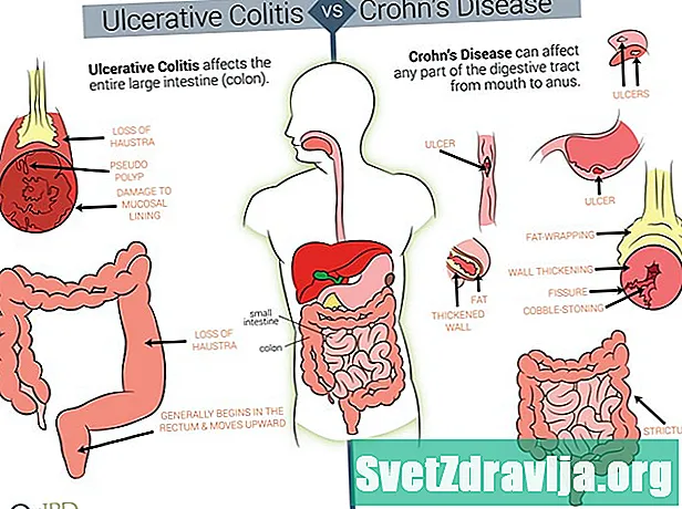 Η σχέση μεταξύ της ελκώδους κολίτιδας, του Crohn και της αναιμίας