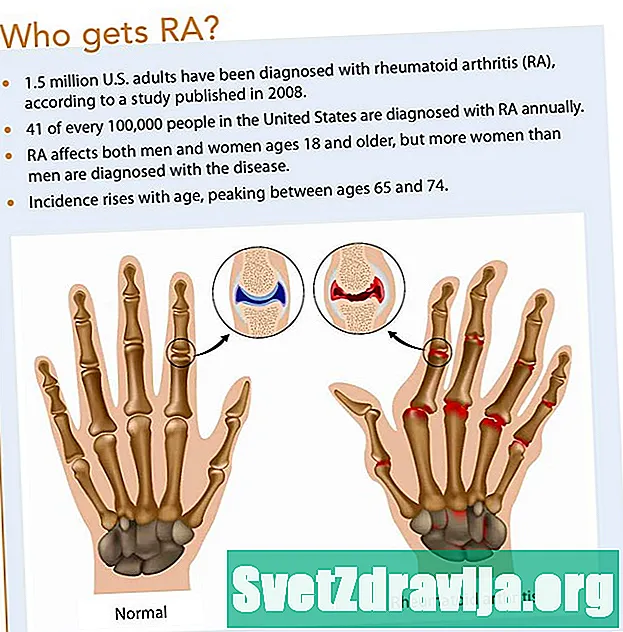 È l'artrite reumatoide? Le differenze tra RA e OA