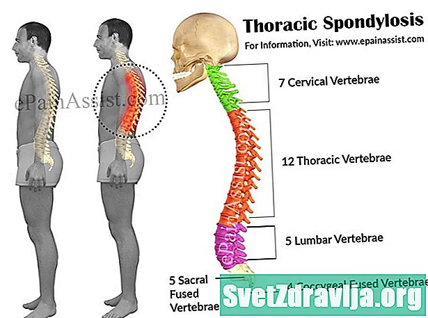 Simptomat dhe trajtimi i spondilozës torakale - Shëndetësor
