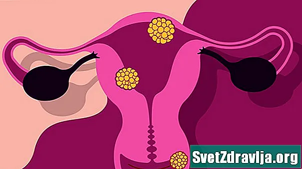 Tips om bacteriële vaginose te behandelen en te voorkomen