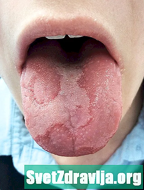 Spálenie jazyka - Zdravie