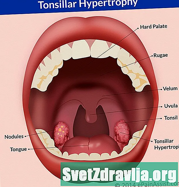 Tonzilių hipertrofija