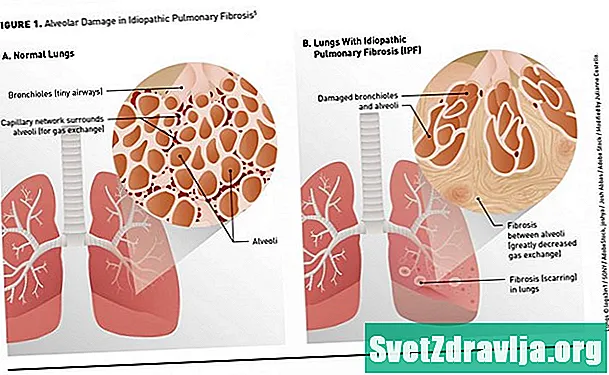Leczenie idiopatycznego zwłóknienia płuc