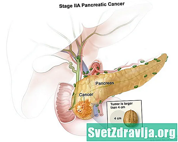 Trajtimi i fazës 4 të kancerit të pankreasit - Shëndetësor
