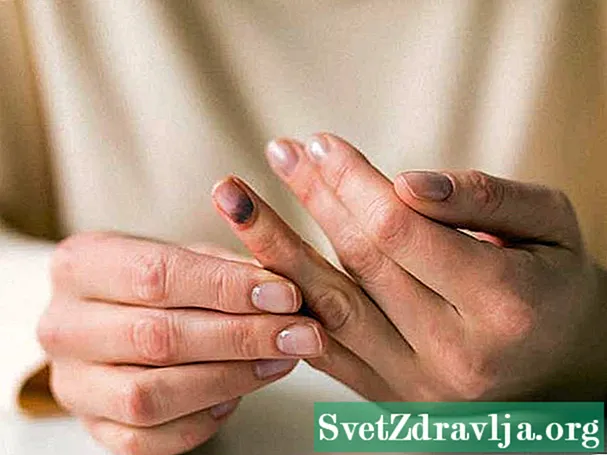 Léčba a zotavení pro rozbitý prst - Wellness
