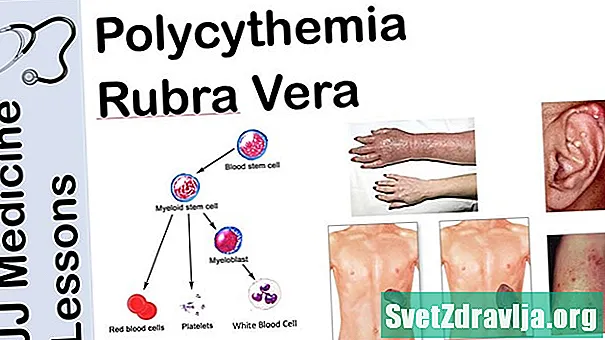 Behandlungsmöglichkeiten für Polyzythämie Vera - Gesundheit