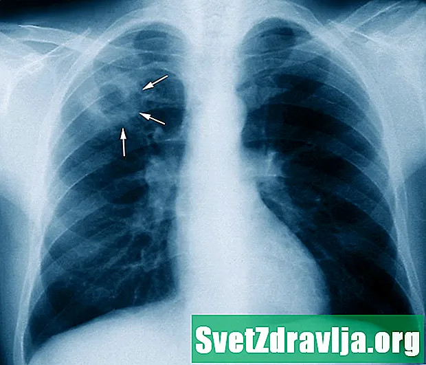 tuberkulóza - Zdravie