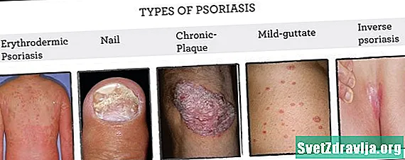 Psoriasis növləri