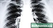 Comprensió de la bronquitis crònica - Benestar