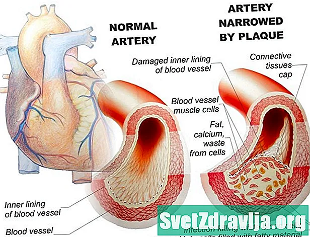 Pag-unawa sa Coronary Artery Disease at Paano Maiiwasan Ito