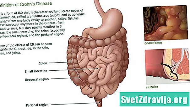 Memahami Penyakit Crohn