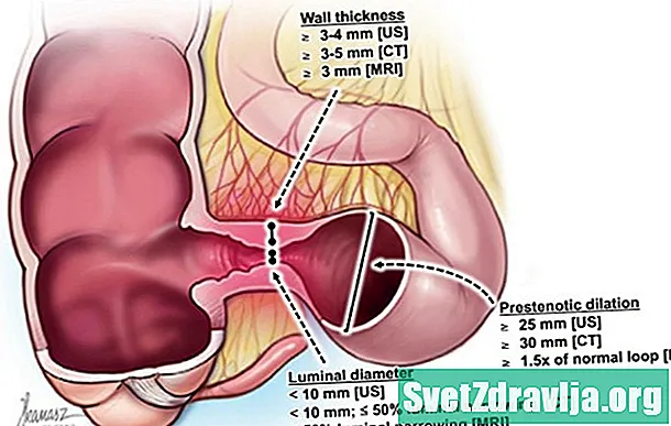 Comprensión de la estenosis intestinal en la enfermedad de Crohn - Salud