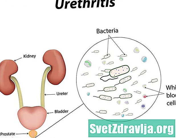 Urethritis