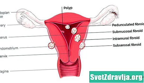 Baarmoeder verwijderen van poliepen: wat te verwachten