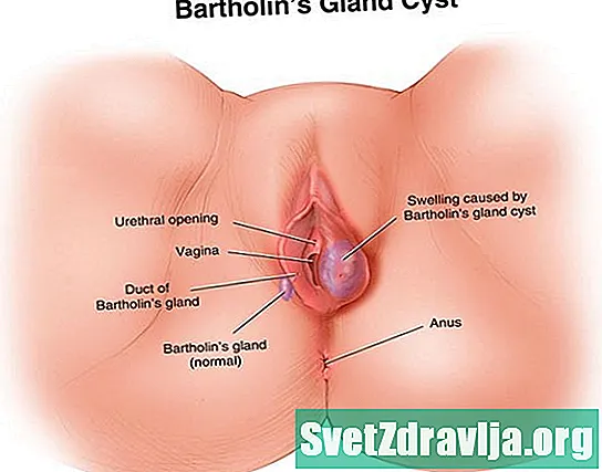 Vaginal cysta