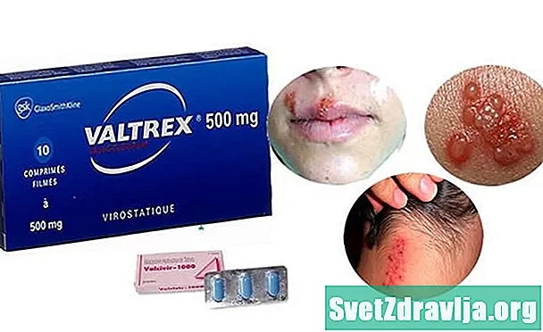 Valtrex治疗唇疱疹：适合您吗？