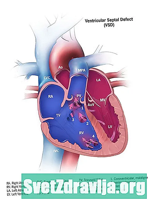 Défauts septaux ventriculaires