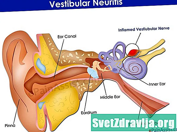 Vestibulárna neuritída - Zdravie