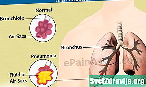 Viral pnevmoniya: simptomlar, risk faktorları və daha çox - Sağlamlıq