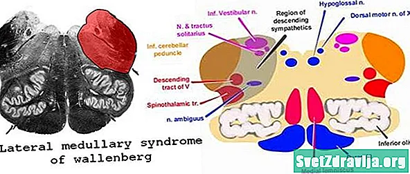 Uollenberg sindromi - Sog'Lik