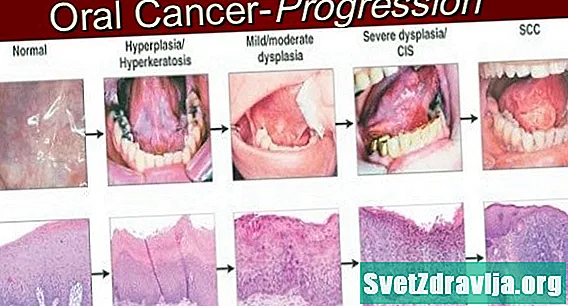 علامات التحذير من سرطان الفم: هل أنت في خطر؟