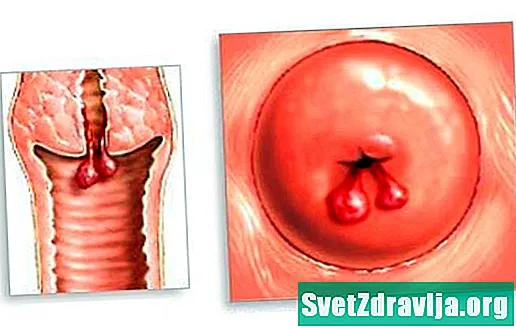 ¿Qué son los pólipos cervicales? - Salud