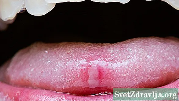 Hva er humper på tungen min?