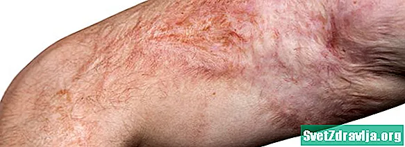¿Qué quemaduras causan cicatrices y cómo se tratan las cicatrices de quemaduras? - Salud