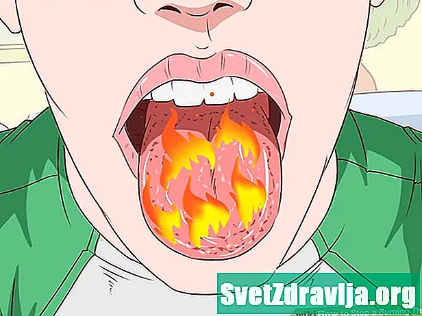 Điều gì gây ra cổ họng bị bỏng và nó được điều trị như thế nào? - SứC KhỏE