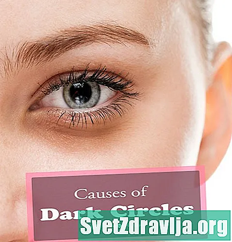 Hvad forårsager mørke cirkler under dine øjne? - Sundhed