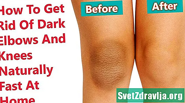 Vad som orsakar mörka knän och hur man lättar dem naturligt - Hälsa