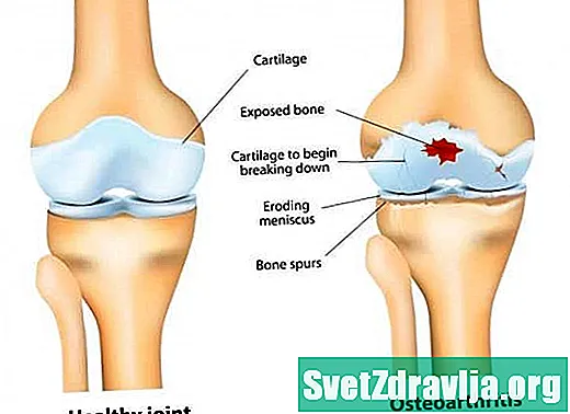 심한 무릎 통증의 일반적인 원인