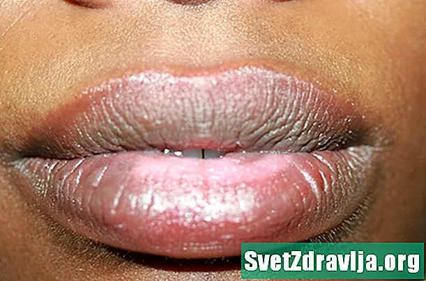 Vad orsakar missfärgning av läppar och hur behandlar du det?