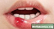Що викликає виразки в роті і як їх лікувати