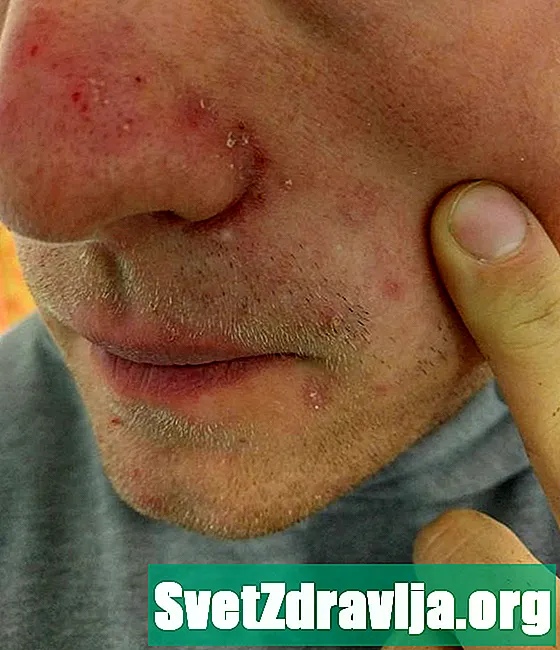 Ce cauzează acneea nasului și cum pot trata asta?