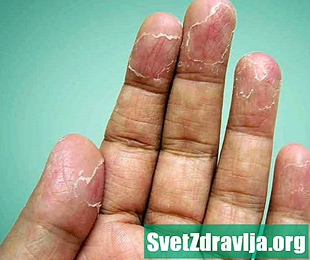 Mi okozza az ujjaik peelingjét és hogyan kezelik? - Egészség