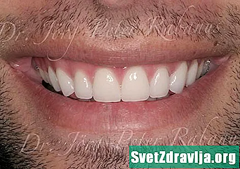 Vad orsakar små tänder?