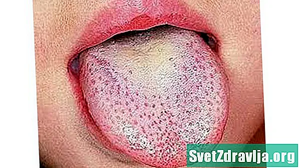 딸기 혀의 원인은 무엇입니까?