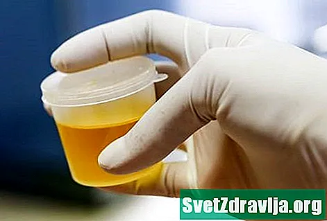 Kaj povzroča, da urin diši po kokicah in kako se to zdravi?