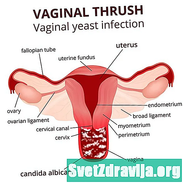 Čo spôsobuje vaginálne kvasinkové infekcie po prenikavom sexe? - Zdravie