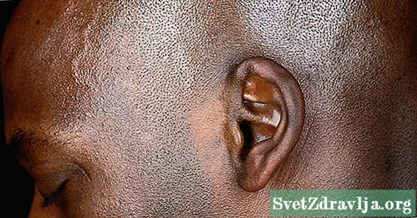 आपकी कान में क्रैकिंग के कारण क्या हो सकता है?