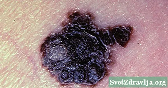 Kaip atrodo 4 stadijos melanomos simptomai?