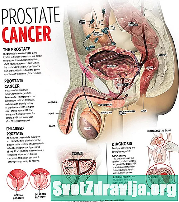 Cosa succede quando il cancro alla prostata si diffonde alle ossa?