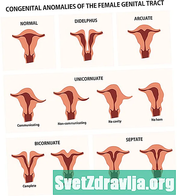 Mis on kahekordne uterus ja kas see mõjutab rasedust? - Tervis