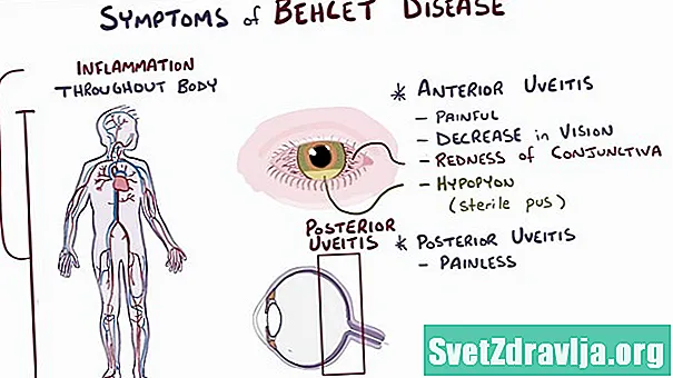 Kas yra Behceto liga?