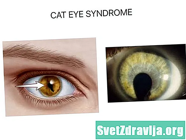 Isfarë është sindromi i syrit të maceve? - Shëndetësor