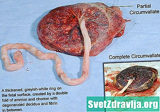 Apa itu Circumvallate Placenta?