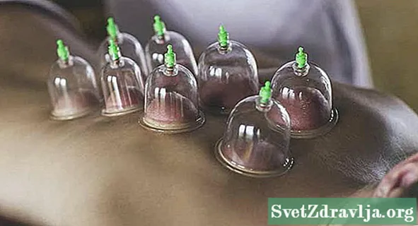 Ano ang Cupping Therapy?
